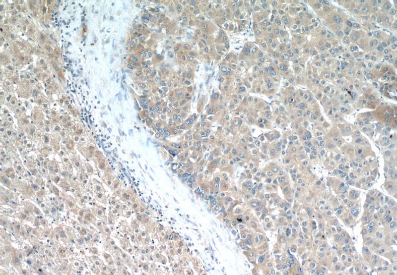Immunohistochemistry of paraffin-embedded human liver cancer tissue slide using Catalog No:112323(LRP5 Antibody) at dilution of 1:50 (under 10x lens)