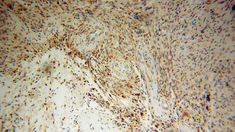 Immunohistochemical of paraffin-embedded human gliomas using Catalog No:109868(DARS2 antibody) at dilution of 1:100 (under 10x lens)