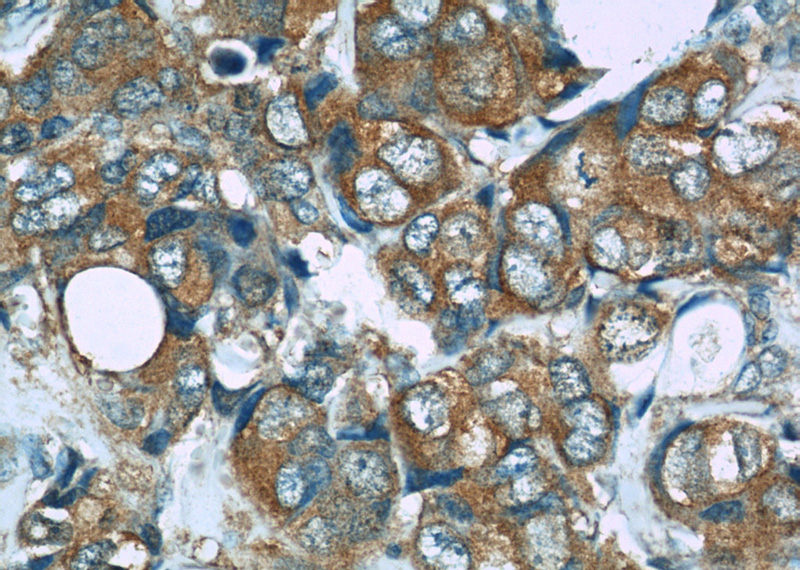 Immunohistochemistry of paraffin-embedded human breast cancer slide using Catalog No:114175(PRDX1 Antibody) at dilution of 1:50