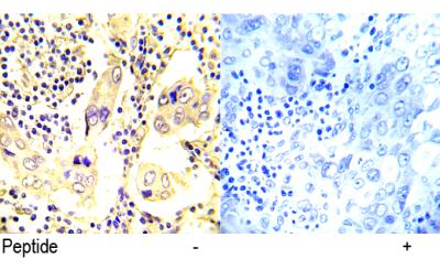 Immunohistochemical analysis of paraffin- embedded human breast carcinoma tissue using SRC (Ab-529) antibody.