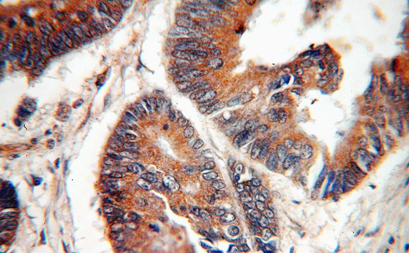 Immunohistochemical of paraffin-embedded human colon cancer using Catalog No:108617(C18orf8 antibody) at dilution of 1:100 (under 40x lens)