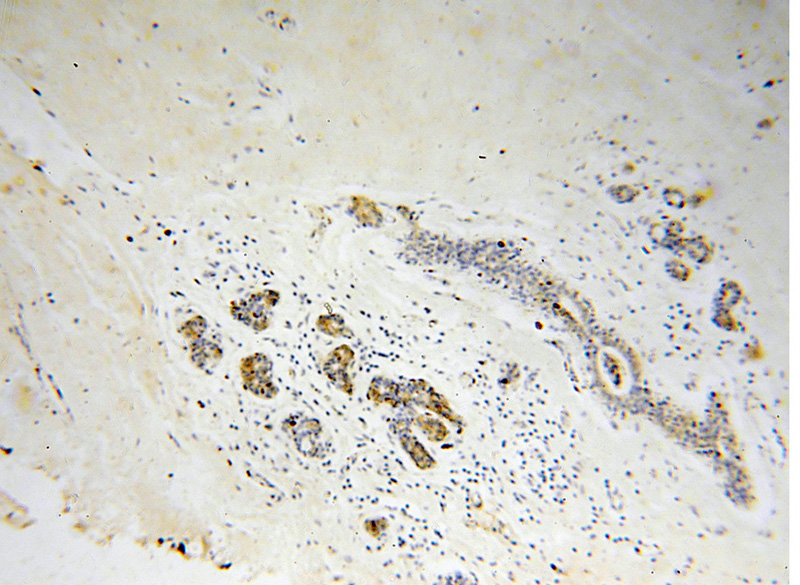 Immunohistochemical of paraffin-embedded human colon cancer using Catalog No:109452(GJB1 antibody) at dilution of 1:50 (under 10x lens)