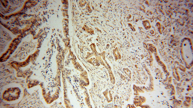 Immunohistochemical of paraffin-embedded human pancreas cancer using Catalog No:116715(VAPB antibody) at dilution of 1:100 (under 10x lens)