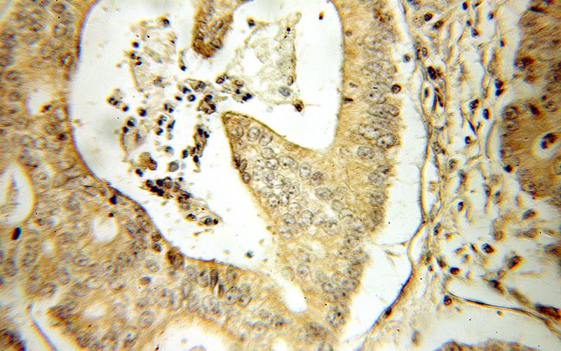 Immunohistochemical of paraffin-embedded human colon cancer using Catalog No:109537(CRABP2 antibody) at dilution of 1:50 (under 10x lens)