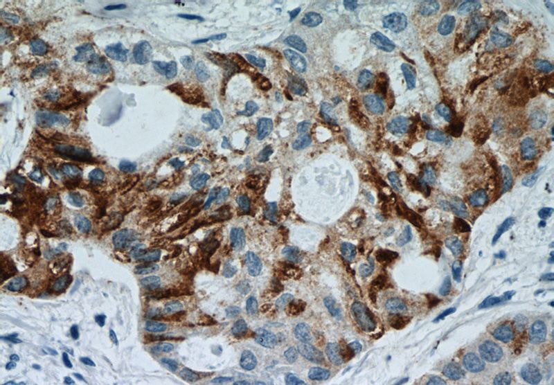 Immunohistochemistry of paraffin-embedded human lung cancer tissue slide using Catalog No:111576(HYAL2 Antibody) at dilution of 1:50 (under 40x lens)