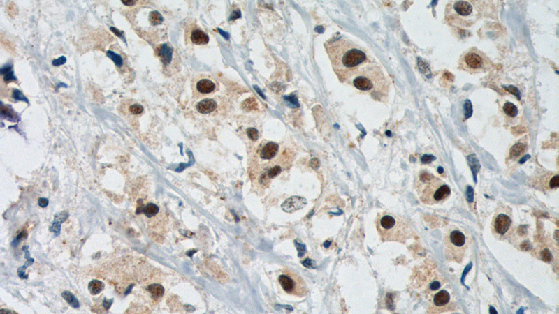 Immunohistochemistry of paraffin-embedded human breast cancer tissue slide using Catalog No:108025(APOBEC3B Antibody) at dilution of 1:200 (under 40x lens). heat mediated antigen retrieved with Tris-EDTA buffer(pH9).