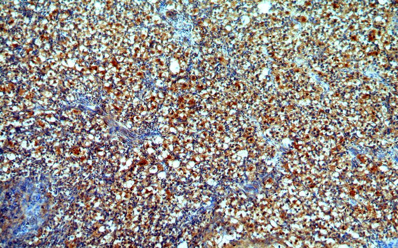 Immunohistochemical of paraffin-embedded human ovary using Catalog No:114067(POTEA-Specific antibody) at dilution of 1:50 (under 10x lens)