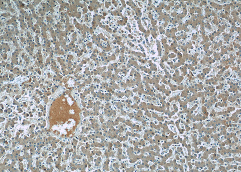 Immunohistochemistry of paraffin-embedded human liver slide using Catalog No:115039(SAA4 Antibody) at dilution of 1:50