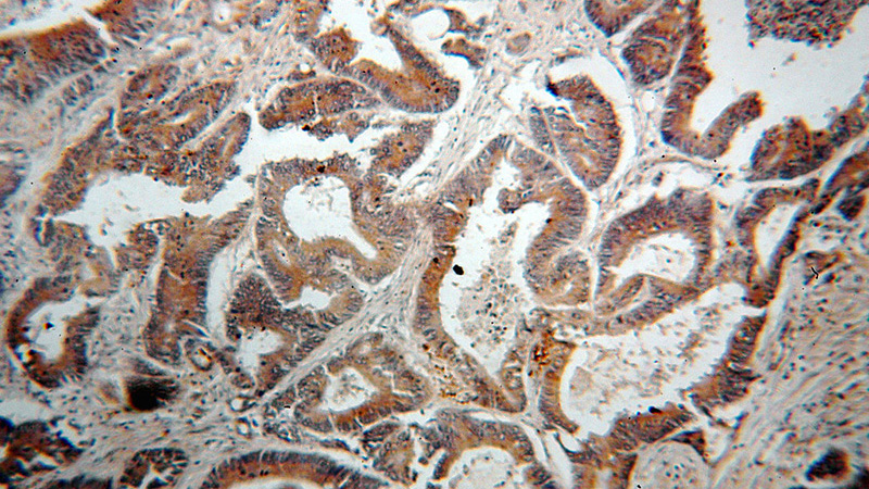 Immunohistochemical of paraffin-embedded human colon cancer using Catalog No:108617(C18orf8 antibody) at dilution of 1:100 (under 10x lens)