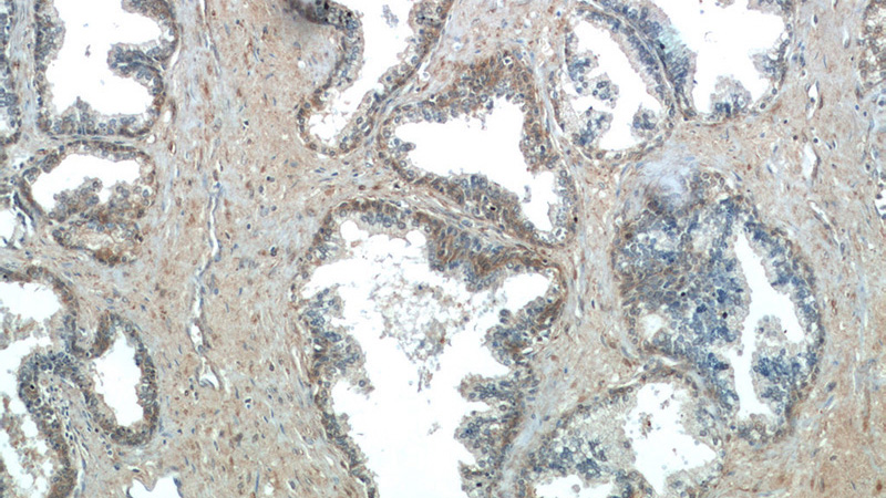 Immunohistochemistry of paraffin-embedded human prostate hyperplasia tissue slide using Catalog No:113490(PAGE2 Antibody) at dilution of 1:50 (under 10x lens)