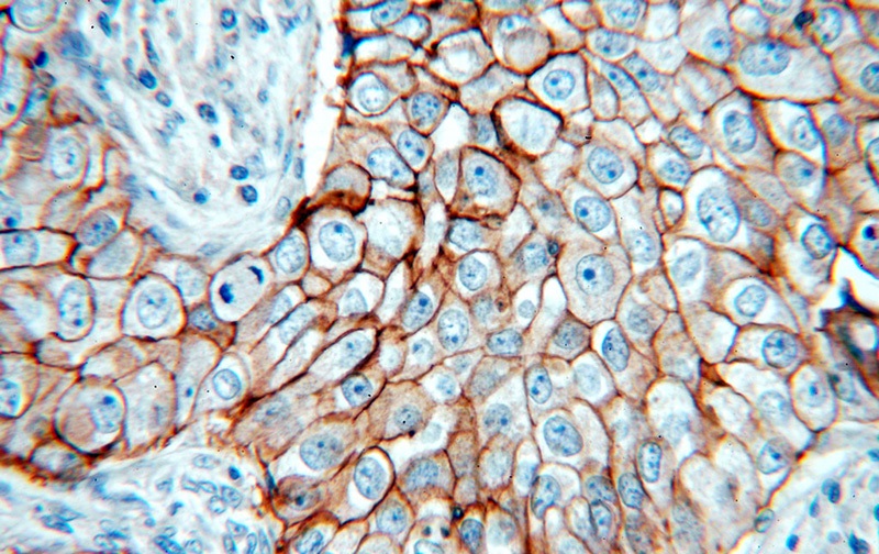 Immunohistochemical of paraffin-embedded human breast cancer using Catalog No:111294(ERBB2 antibody) at dilution of 1:50 (under 40x lens)
