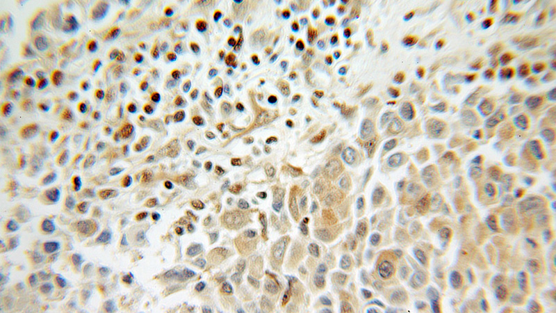 Immunohistochemical of paraffin-embedded human breast cancer using Catalog No:117317(GAPDH antibody) at dilution of 1:100 (under 10x lens)