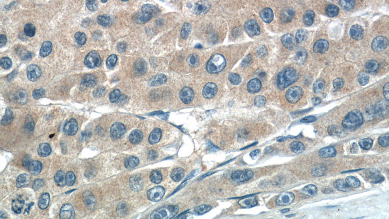 Immunohistochemistry of paraffin-embedded human liver cancer tissue slide using Catalog No:107061(APOA1 Antibody) at dilution of 1:50 (under 40x lens)