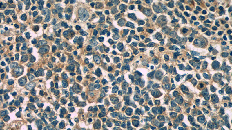 Immunohistochemistry of paraffin-embedded human tonsillitis tissue slide using Catalog No:107401(IL4 Antibody) at dilution of 1:50 (under 40x lens)