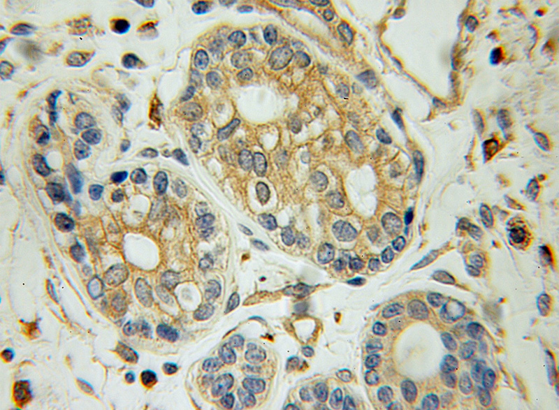 Immunohistochemical of paraffin-embedded human breast cancer using Catalog No:109878(DBNL antibody) at dilution of 1:100 (under 10x lens)