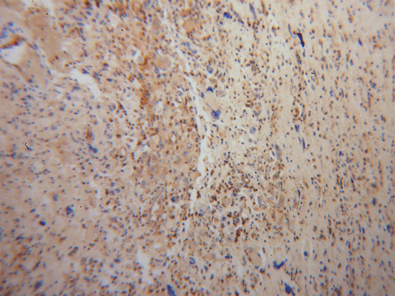 Immunohistochemical of paraffin-embedded human gliomas using Catalog No:111957(ITPKA antibody) at dilution of 1:100 (under 10x lens)
