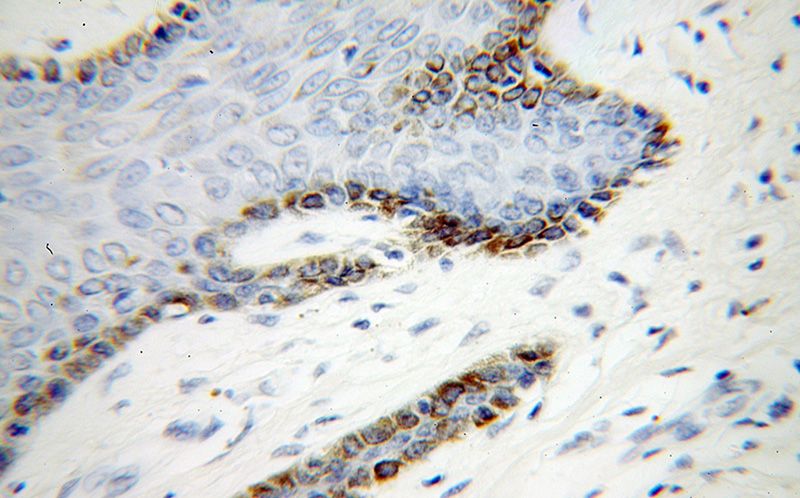 Immunohistochemical of paraffin-embedded human skin cancer using Catalog No:116533(UBE2Q2 antibody) at dilution of 1:100 (under 40x lens)