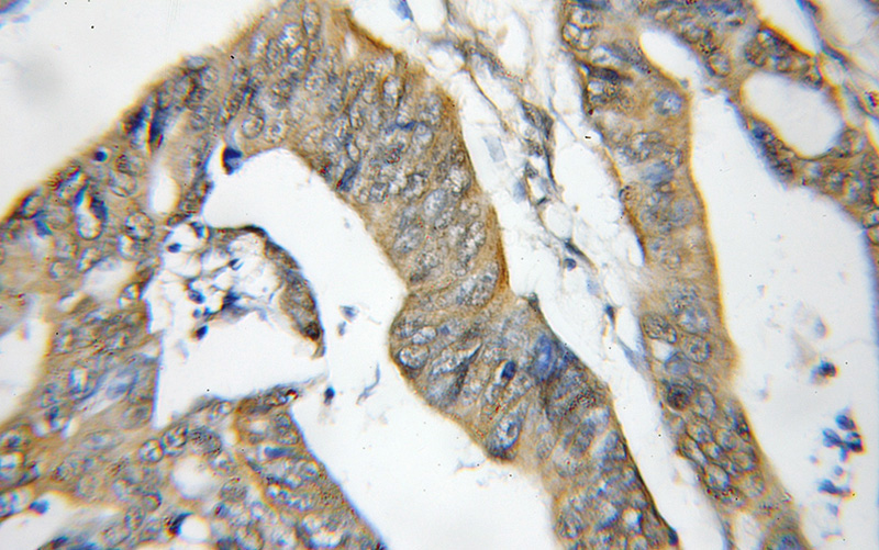 Immunohistochemical of paraffin-embedded human colon cancer using Catalog No:109111(CDC6 antibody) at dilution of 1:50 (under 10x lens)