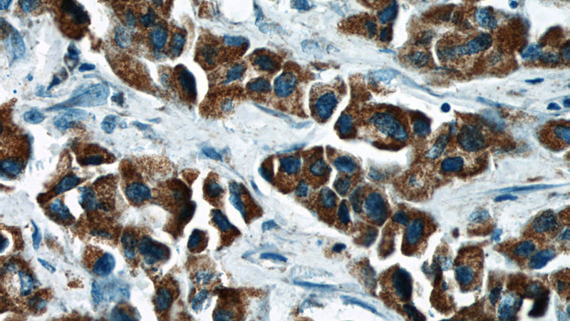 Immunohistochemical of paraffin-embedded human breast cancer using Catalog No:112646(MAP2K4 antibody) at dilution of 1:50 (under 40x lens)