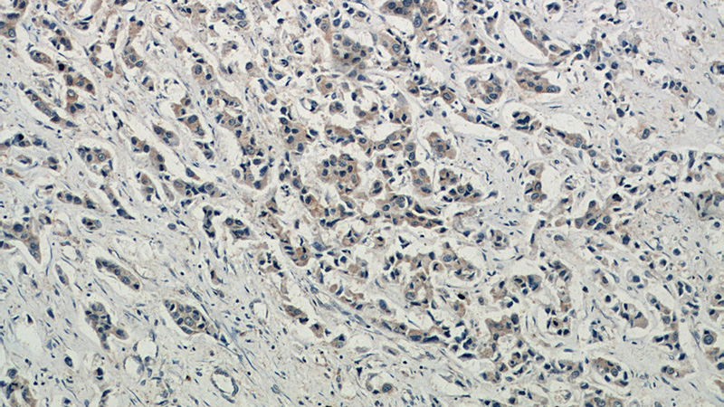 Immunohistochemical of paraffin-embedded human breast cancer using Catalog No:107947(AKT1 antibody) at dilution of 1:50 (under 10x lens)