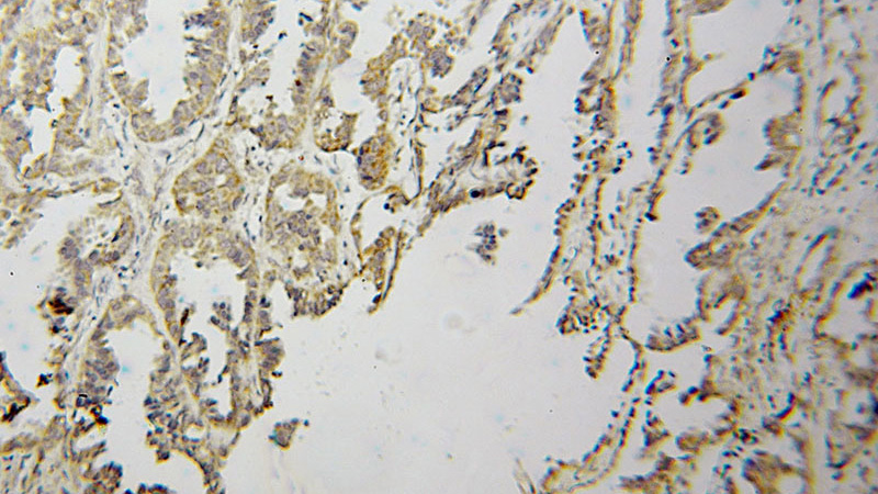 Immunohistochemical of paraffin-embedded human lung cancer using Catalog No:114028(PMPCB antibody) at dilution of 1:100 (under 10x lens)