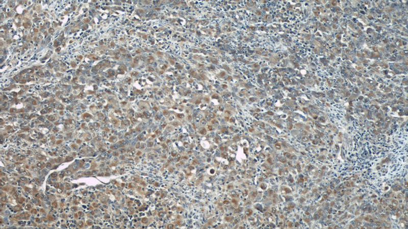 Immunohistochemical of paraffin-embedded human lymphoma using Catalog No:116905(ZAP70 antibody) at dilution of 1:50 (under 10x lens)
