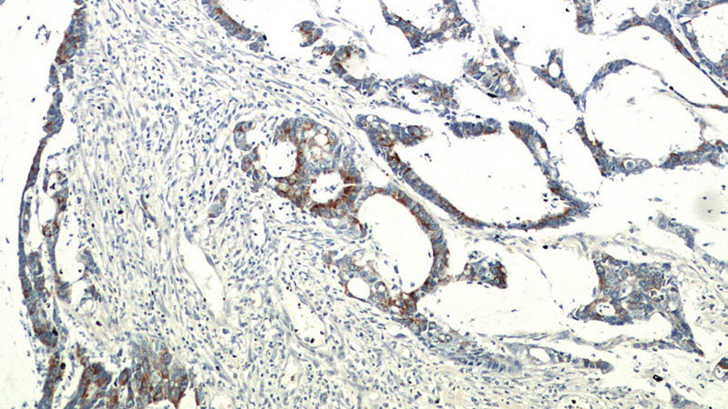 Immunohistochemical of paraffin-embedded human colon cancer using Catalog No:115647(SPRR3 antibody) at dilution of 1:100 (under 10x lens)