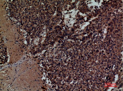 Fig2:; Immunohistochemical analysis of paraffin-embedded human-lung-cancer, antibody was diluted at 1:100