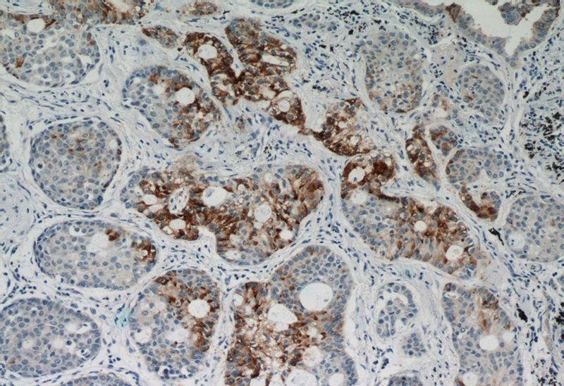 Immunohistochemistry of paraffin-embedded human lung cancer tissue slide using Catalog No:111576(HYAL2 Antibody) at dilution of 1:50 (under 10x lens)