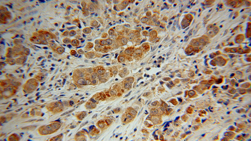 Immunohistochemical of paraffin-embedded human prostate cancer using Catalog No:111075(GLUD2 antibody) at dilution of 1:100 (under 40x lens)