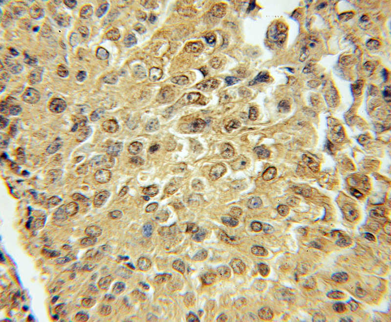 Immunohistochemical of paraffin-embedded human lung cancer using Catalog No:108183(ARHGEF10 antibody) at dilution of 1:50 (under 10x lens)