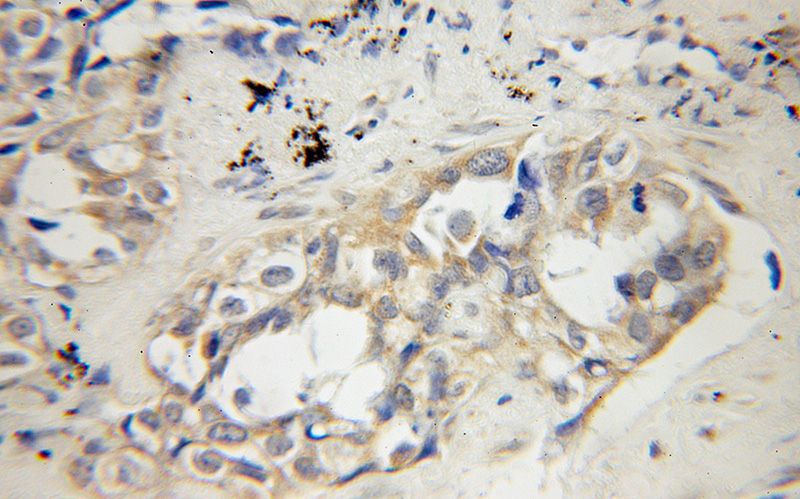 Immunohistochemical of paraffin-embedded human lung cancer using Catalog No:109118(CDCA8 antibody) at dilution of 1:50 (under 10x lens)