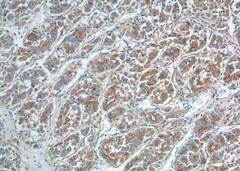 Immunohistochemistry of paraffin-embedded human liver cancer tissue slide using Catalog No:108055(ANGPTL1 Antibody) at dilution of 1:50 (under 10x lens).
