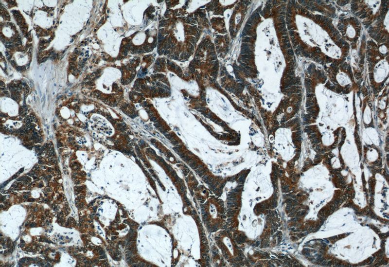Immunohistochemical of paraffin-embedded human colon cancer using Catalog No:110363(ERK1 antibody) at dilution of 1:50 (under 10x lens)