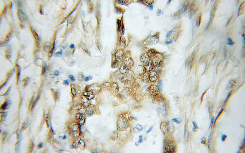 Immunohistochemical of paraffin-embedded human pancreas cancer using Catalog No:116686(USP48 antibody) at dilution of 1:100 (under 10x lens)