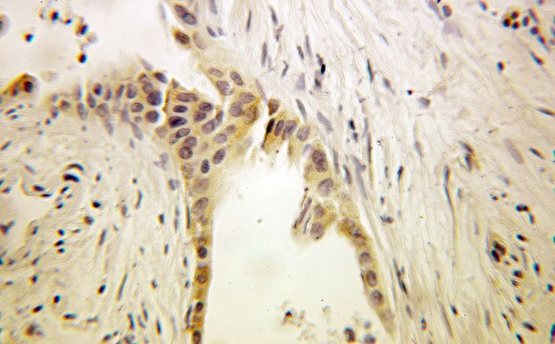 Immunohistochemical of paraffin-embedded human pancreas cancer using Catalog No:110312(EEF1B2 antibody) at dilution of 1:100 (under 25x lens)