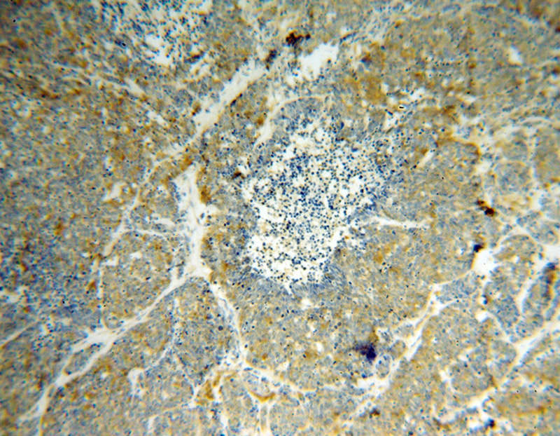 Immunohistochemical of paraffin-embedded human lung cancer using Catalog No:117125(ARRB1 antibody) at dilution of 1:100 (under 10x lens)