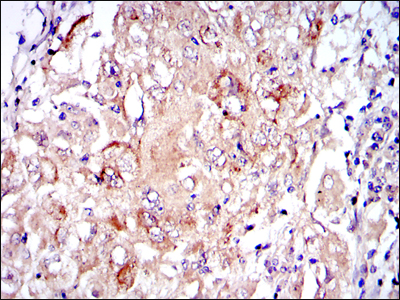 Immunohistochemical analysis of paraffin-embedded lung cancer tissues using PRK2 mouse mAb with DAB staining.