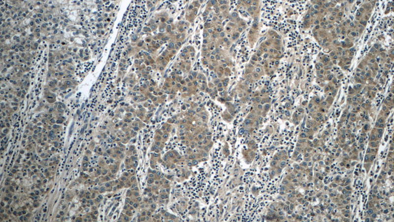 Immunohistochemistry of paraffin-embedded human liver cancer tissue slide using Catalog No:112043(FAM30A Antibody) at dilution of 1:50 (under 10x lens)