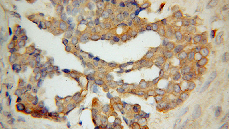 Immunohistochemical of paraffin-embedded human ovary tumor using Catalog No:116413(WARS antibody) at dilution of 1:100 (under 40x lens)