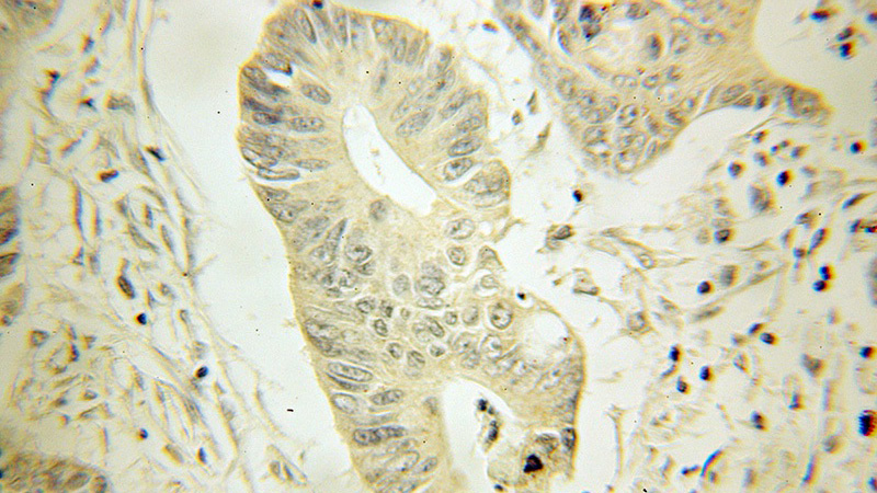 Immunohistochemical of paraffin-embedded human colon cancer using Catalog No:111448(HPGD antibody) at dilution of 1:50 (under 25x lens)