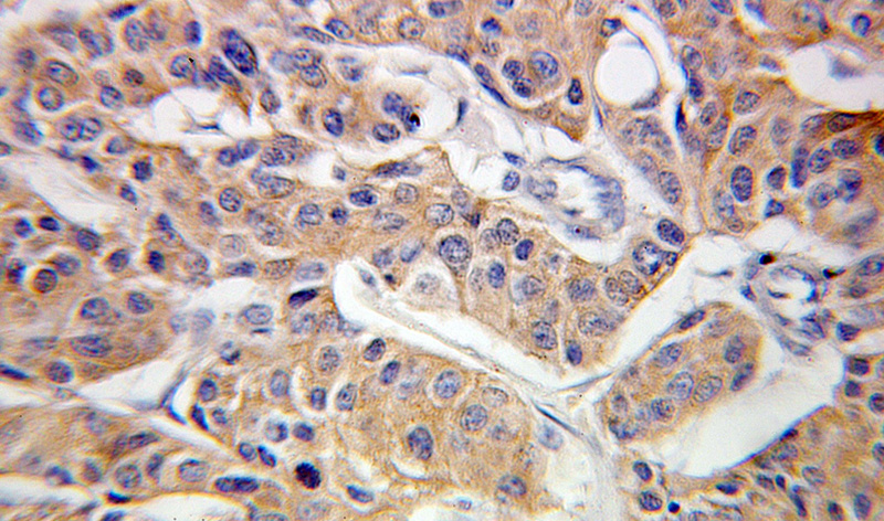Immunohistochemical of paraffin-embedded human breast cancer using Catalog No:109391(CLINT1 antibody) at dilution of 1:100 (under 40x lens)
