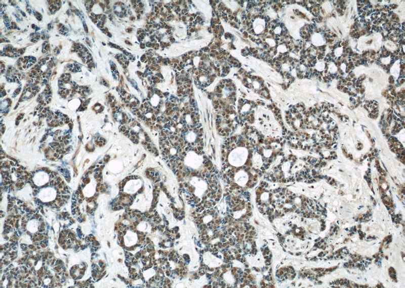 Immunohistochemical of paraffin-embedded human cervical cancer using Catalog No:107568(AKT antibody) at dilution of 1:50 (under 10x lens)