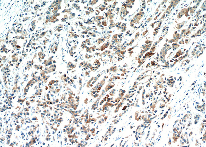 Immunohistochemical of paraffin-embedded human breast cancer using Catalog No:111765(IL17RB antibody) at dilution of 1:100 (under 10x lens)