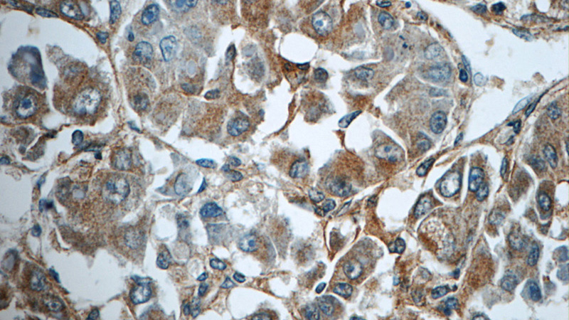 Immunohistochemistry of paraffin-embedded human liver cancer tissue slide using Catalog No:112853(MRPS26 Antibody) at dilution of 1:50 (under 40x lens)