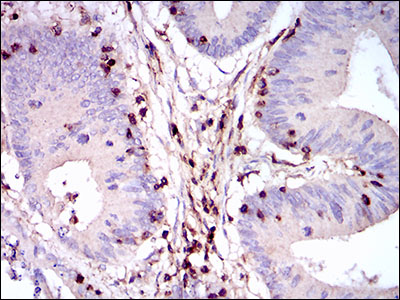 Immunohistochemical analysis of paraffin-embedded colon cancer tissues using PTPRC mouse mAb with DAB staining.