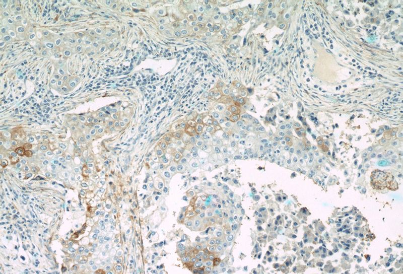 Immunohistochemistry of paraffin-embedded human breast cancer tissue slide using Catalog No:110402(ERBB3 Antibody) at dilution of 1:200 (under 10x lens)
