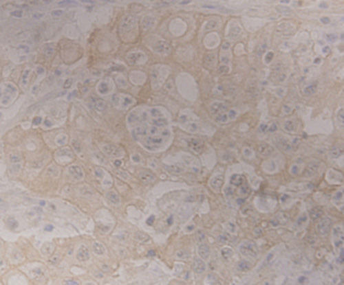 Fig9: Immunohistochemical analysis of paraffin-embedded human gastric adenocarcinoma tissue using anti-GRAMD1A antibody. Counter stained with hematoxylin.