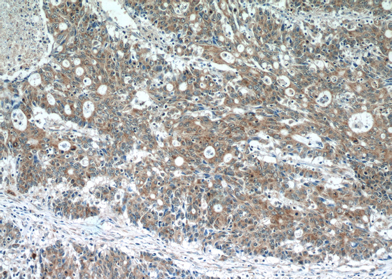 Immunohistochemistry of paraffin-embedded human colon cancer tissue slide using Catalog No:107927(AKAP1 Antibody) at dilution of 1:50 (under 10x lens)