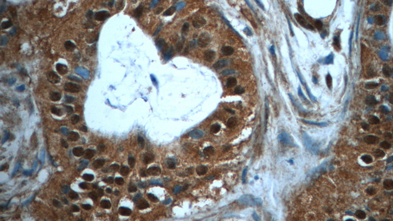 Immunohistochemistry of paraffin-embedded human breast cancer tissue slide using Catalog No:114607(RBM25 Antibody) at dilution of 1:50 (under 40x lens)